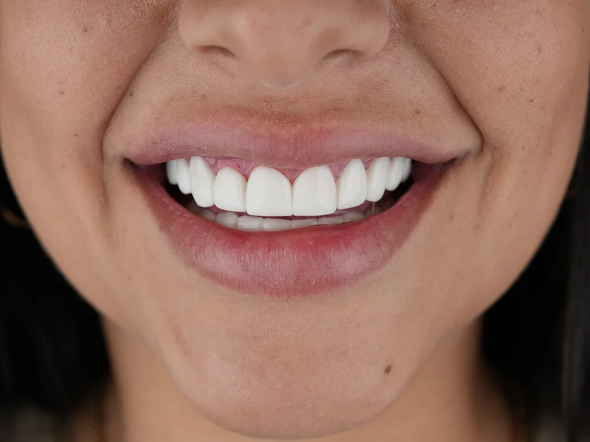 After — Carillas Dentales — Smile Dental Center