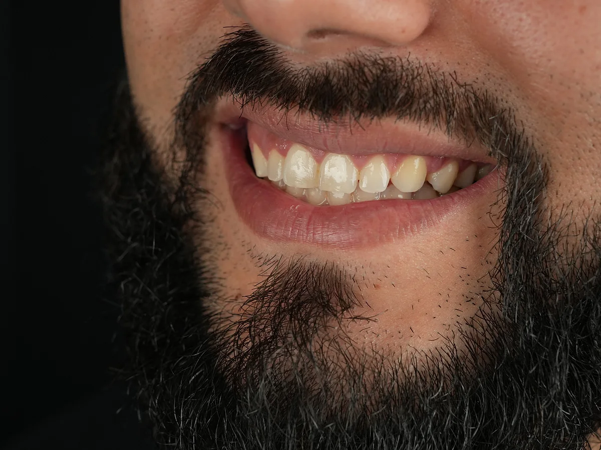 Before — Diseño de Sonrisa con Carillas